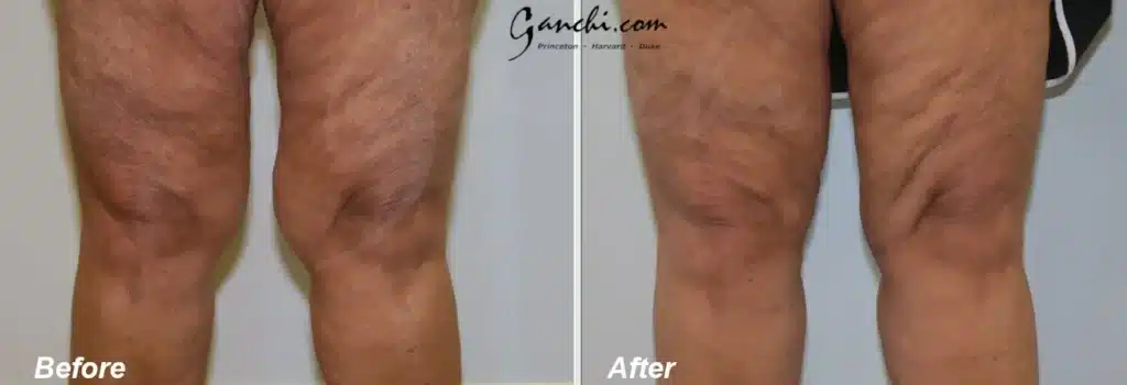 Front View Leg Liposuction Before and After Photo by Ganchi Plastic Surgery