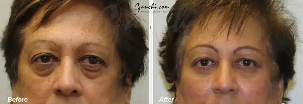 Front View Lower Blepharoplasty Before and After Photo by Ganchi Plastic Surgery