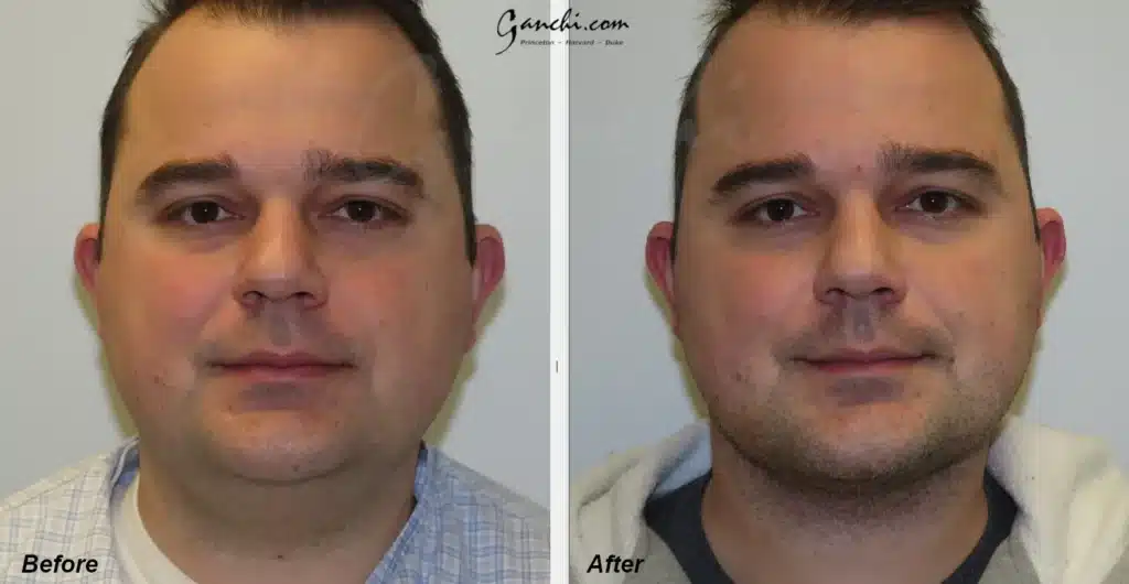 Front View Neck Liposuction Before and After Photo by Ganchi Plastic Surgery