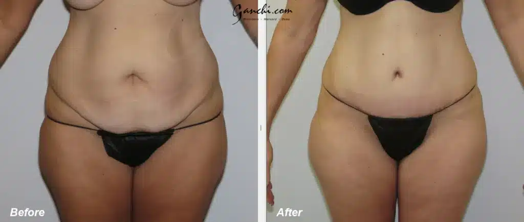 Front View Tummy Tuck Before and After Photo by Ganchi Plastic Surgery