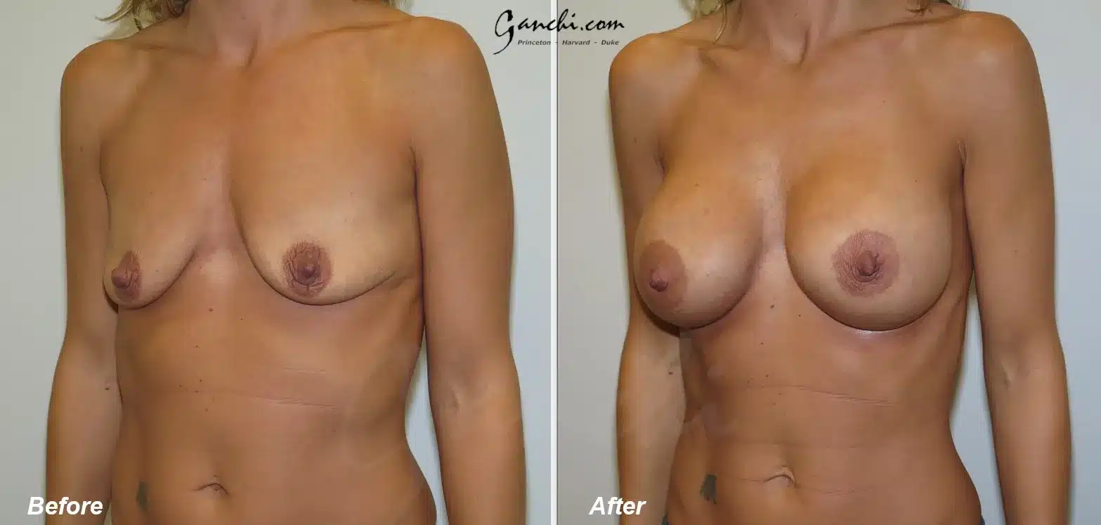 Left Oblique View Breast Augmentation Before and After Photo by Ganchi Plastic Surgery Left Oblique View Breast Augmentation Before and After Photo by Ganchi Plastic Surgery