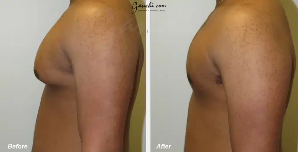 Left Side View Gynecomastia Before and After Photo by Ganchi Plastic Surgery