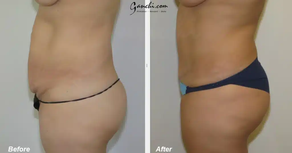 Left Side View Tummy Tuck Before and After Photo by Ganchi Plastic Surgery