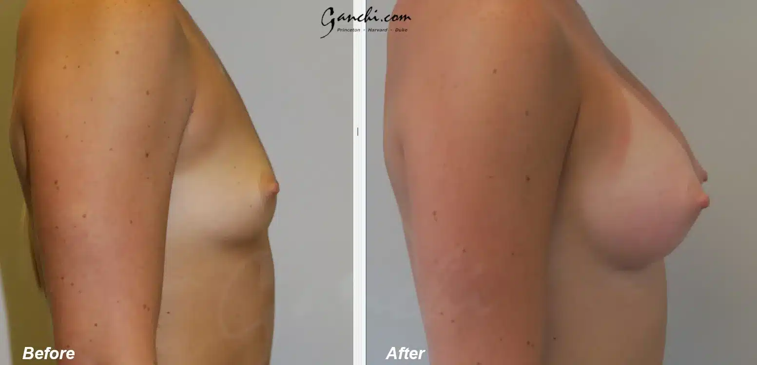 Right Side View Breast Augmentation Before and After Photo by Ganchi Plastic Surgery Right Side View Breast Augmentation Before and After Photo by Ganchi Plastic Surgery