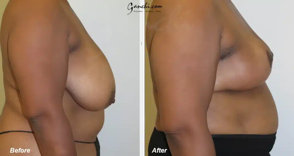 Right Side View Breast Reduction Before and After Photo by Ganchi Plastic Surgery