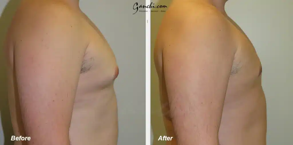 Right Side View Gynecomastia Before and After Photo by Ganchi Plastic Surgery